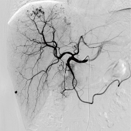 angiography machine